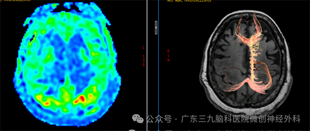 三九脑科神外六行“脊髓电刺激术SCS”为植物人苏醒带来新希望